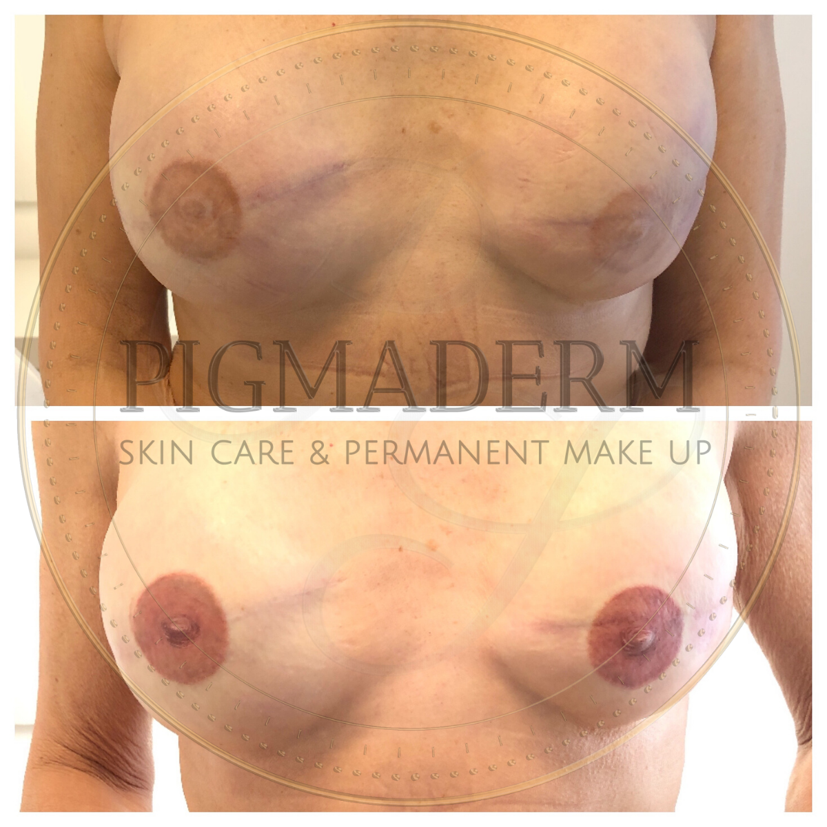 Dermopigmentation aréoles mammaires - tatouage 3D mammaires